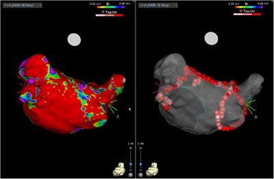 Convergent approach to persistent atrial fibrillation ablation: long-term single-centre safety and efficacy
